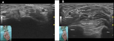 Agreement Between High-Resolution Ultrasound and Electro-Physiological Examinations for Diagnosis of Carpal Tunnel Syndrome in the Indonesian Population